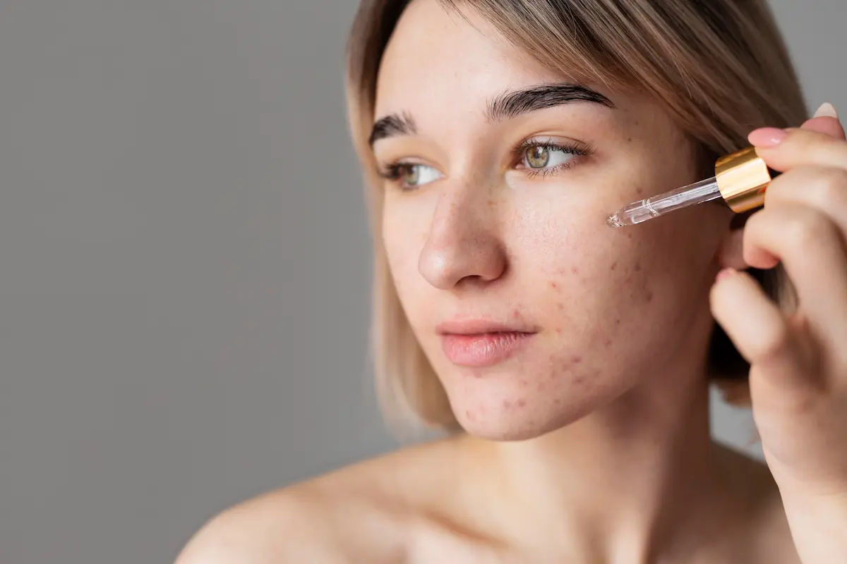 Acne Treatment